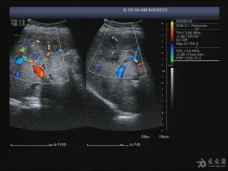 酒精肝病人怎么补硒（硒对酒精有分解作用吗）-硒宝网