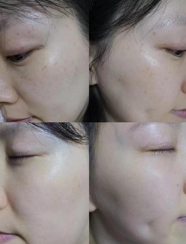 补硒可以去除色斑吗（去除色斑补硒可以吗）-硒宝网