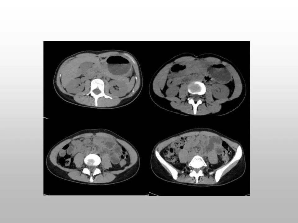 胃癌晚期补硒有用吗（胃癌晚期补硒能吸收吗）-硒宝网
