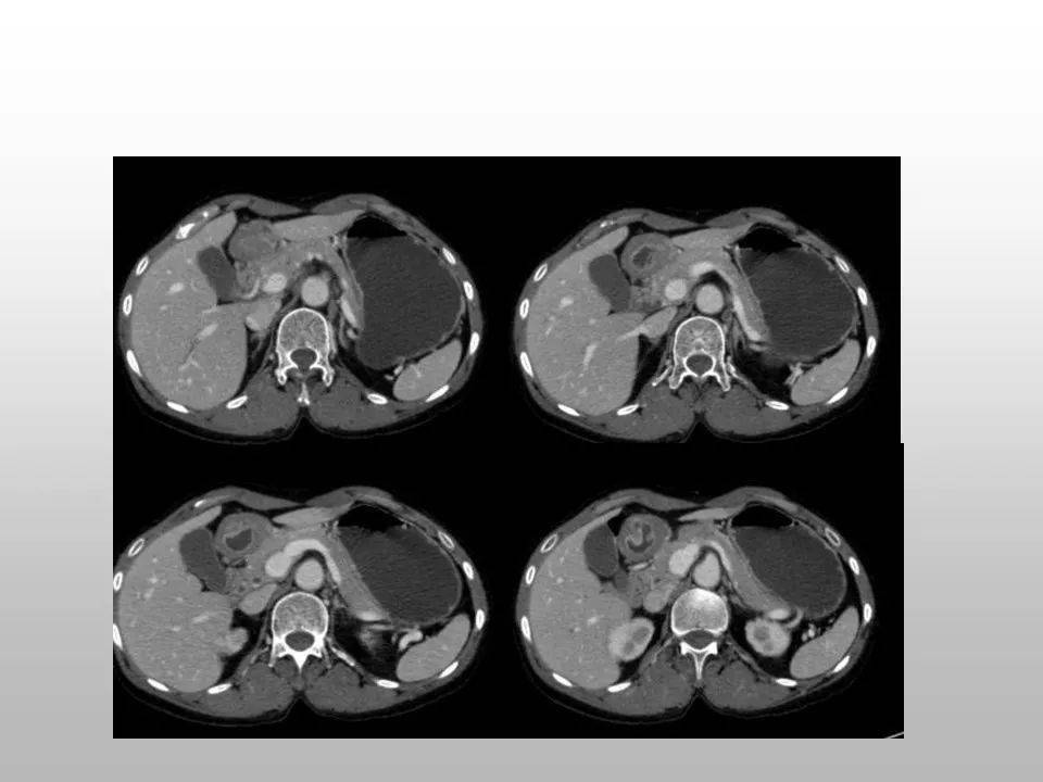 胃癌晚期补硒有用吗（胃癌晚期补硒能吸收吗）-硒宝网