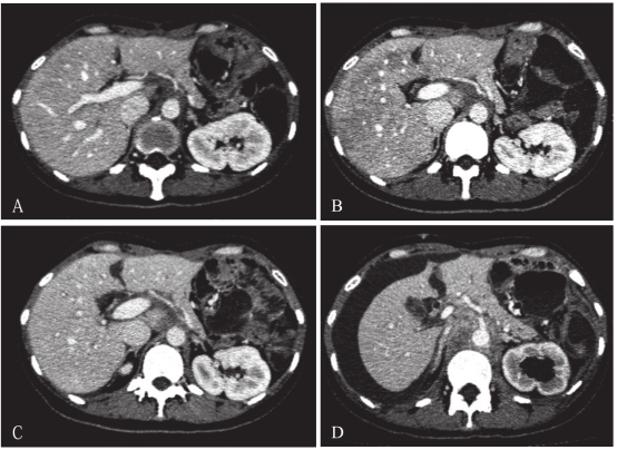 胃癌晚期补硒有用吗（胃癌晚期补硒能吸收吗）-硒宝网