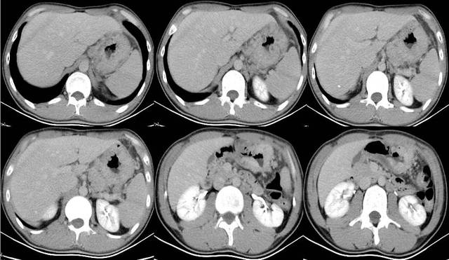 胃癌晚期补硒有用吗（胃癌晚期补硒能吸收吗）-硒宝网