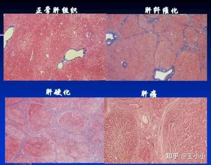 补硒茶对乙肝的影响（补茶乙肝影响硒吸收吗）-硒宝网