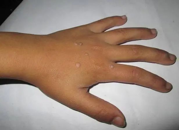 补硒会影响长痘痘吗(痘痘补长影响硒会吸收吗)-硒宝网