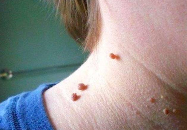 补硒会影响长痘痘吗(痘痘补长影响硒会吸收吗)-硒宝网