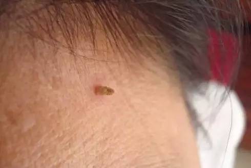 补硒会影响长痘痘吗(痘痘补长影响硒会吸收吗)-硒宝网