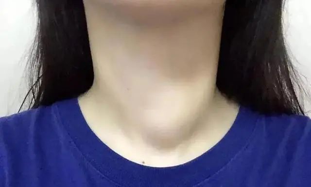 补硒能消体内结节吗（硒对结节的作用）-硒宝网