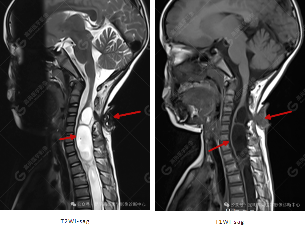 补硒能治疗骶管囊肿（骶管囊肿吃什么药可以让囊变小）-硒宝网