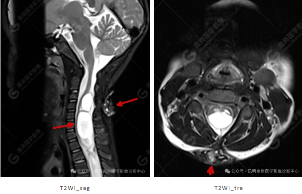 补硒能治疗骶管囊肿（骶管囊肿吃什么药可以让囊变?。?硒宝网