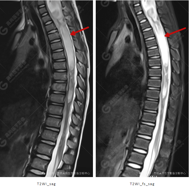 补硒能治疗骶管囊肿（骶管囊肿吃什么药可以让囊变?。?硒宝网