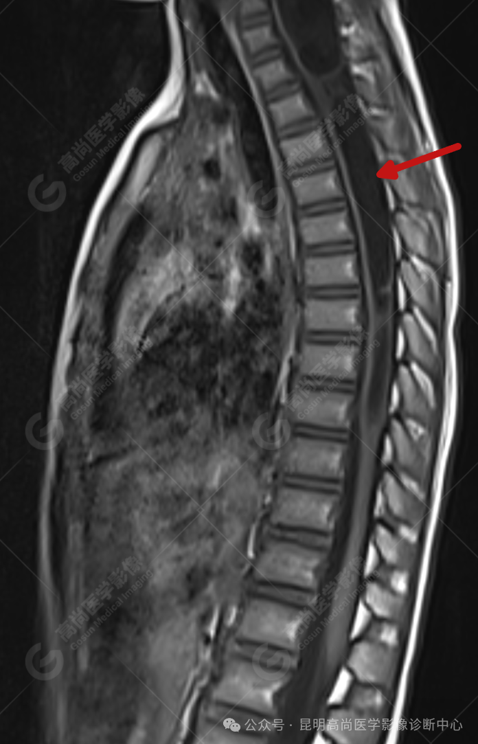补硒能治疗骶管囊肿（骶管囊肿吃什么药可以让囊变小）-硒宝网