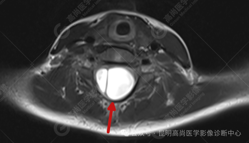 补硒能治疗骶管囊肿（骶管囊肿吃什么药可以让囊变?。?硒宝网