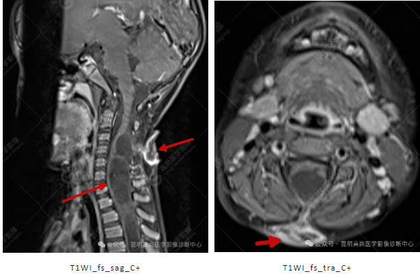 补硒能治疗骶管囊肿（骶管囊肿吃什么药可以让囊变?。?硒宝网