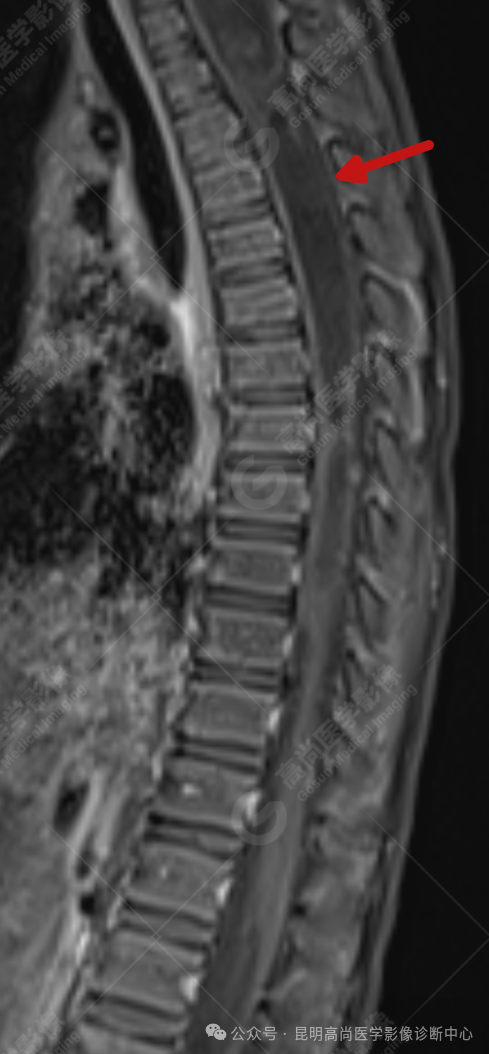 补硒能治疗骶管囊肿（骶管囊肿吃什么药可以让囊变小）-硒宝网