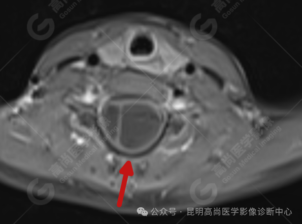 补硒能治疗骶管囊肿（骶管囊肿吃什么药可以让囊变?。?硒宝网