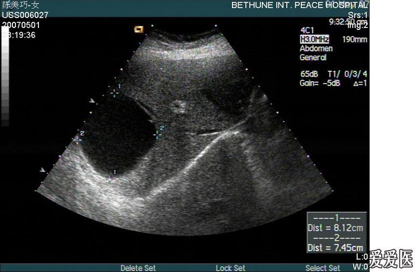 补硒能治皮脂囊肿吗(有没有治疗皮脂腺囊肿的药物)-硒宝网
