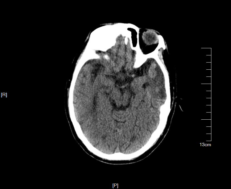 补硒能治皮脂囊肿吗(有没有治疗皮脂腺囊肿的药物)-硒宝网