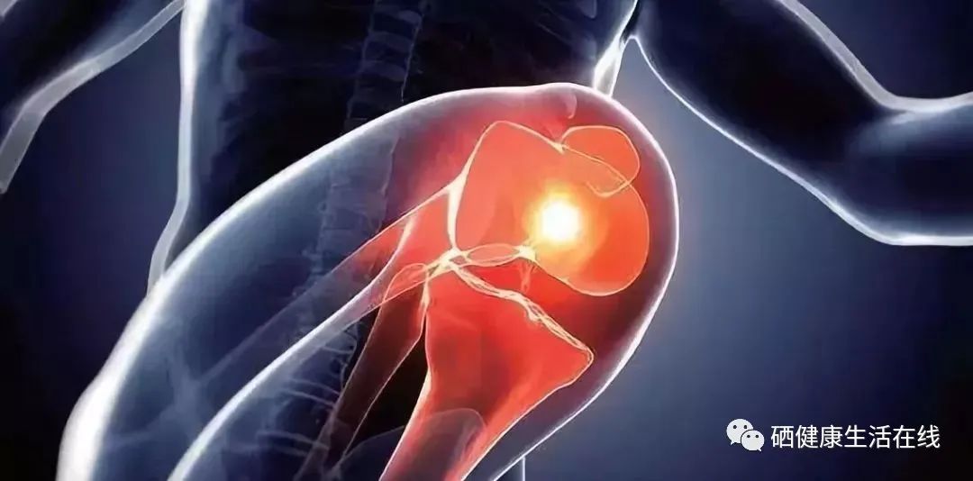 补硒可以改善类风湿（硒与风湿骨关节疾病的关系）-硒宝网