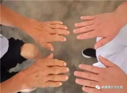 补硒可以改善类风湿（硒与风湿骨关节疾病的关系）-硒宝网