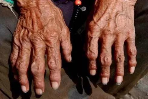 补硒对过敏有作用吗（硒有抗过敏的作用吗）-硒宝网