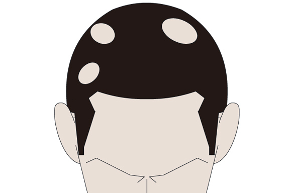 吃补硒药会不会斑秃（吃斑秃的药有哪些）-硒宝网