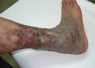 补硒对脑血栓的好处(补硒对脑梗有哪些作用)-硒宝网