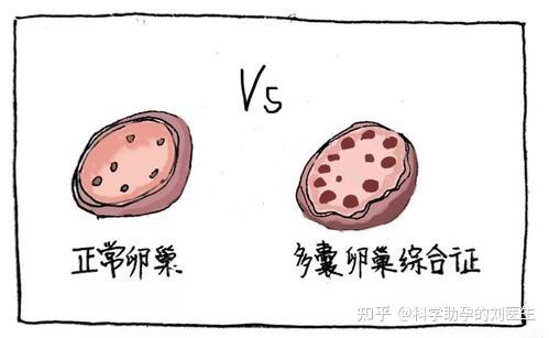 卵巢多囊可以补硒吗（多囊可以补充硒片吗）-硒宝网