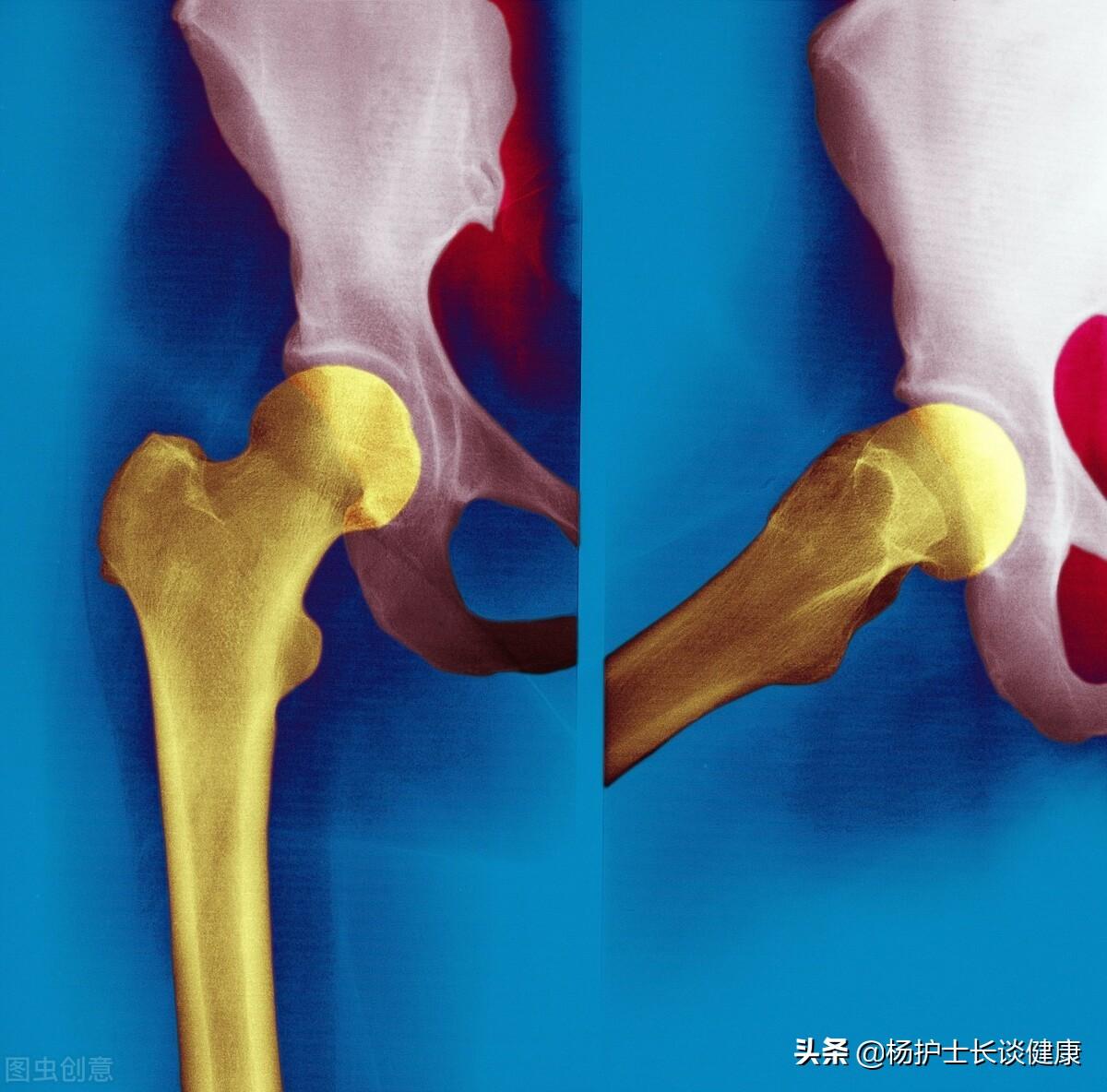 骨质疏松如何补钙（补钙骨质疏松吃什么钙片好）-硒宝网