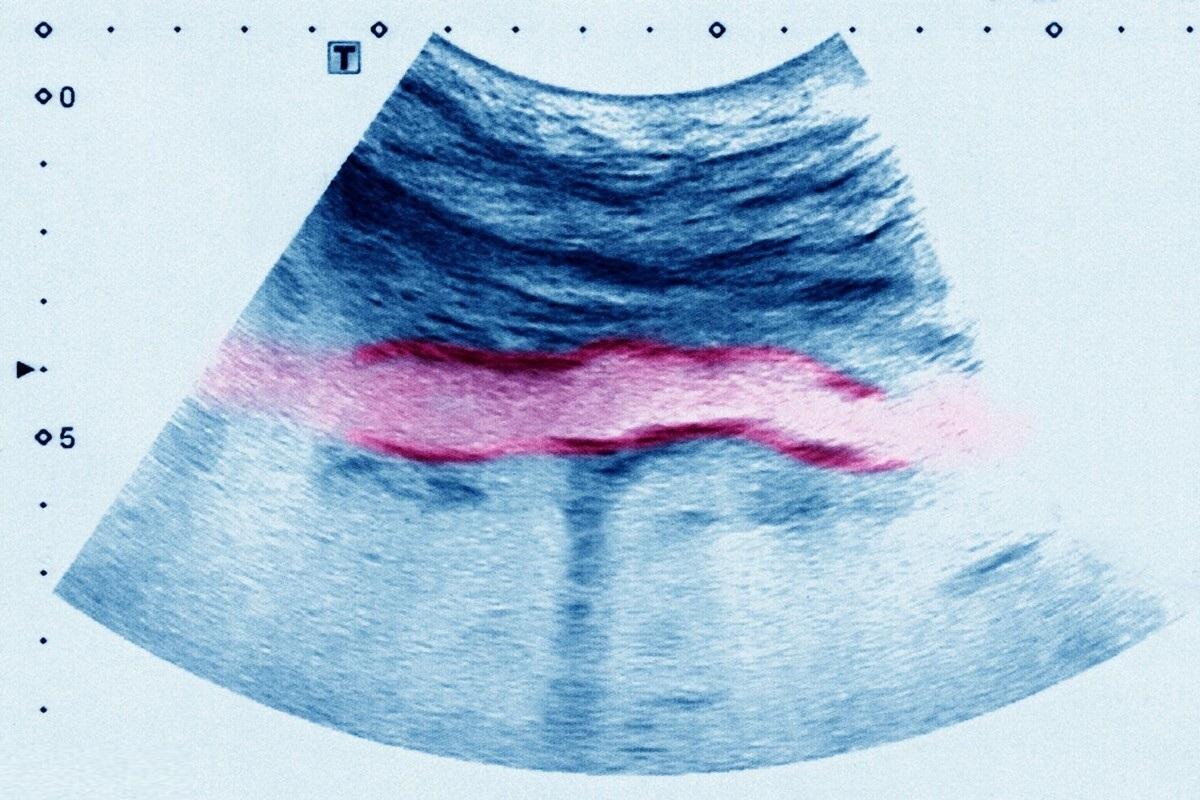 骨质疏松如何补钙(补骨质疏松的钙片有哪些)-硒宝网