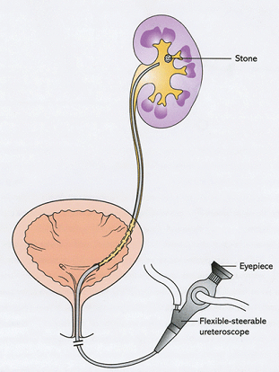 肾结石患者如何补钙(肾结石患者补钙吃什么药)-硒宝网