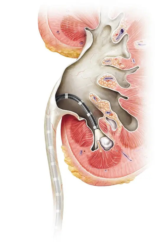 肾结石患者如何补钙(肾结石患者补钙吃什么药)-硒宝网
