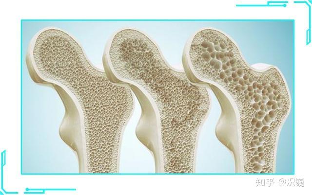 肾结石患者如何补钙(肾结石补钙患者吃什么)-硒宝网