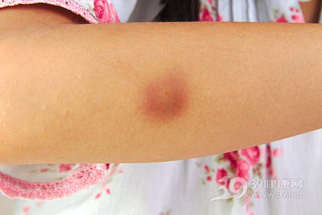 补硒后皮肤干燥的很（干燥补皮肤硒后会怎么样）-硒宝网