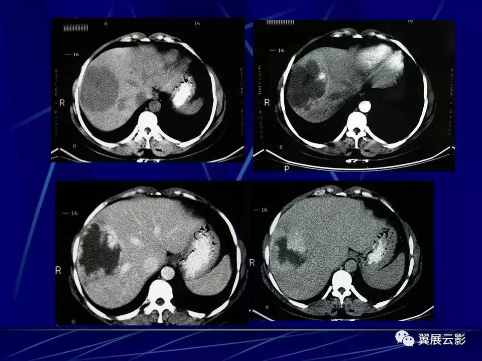 补硒对肝硬化的疗效（肝硬化吃硒管用吗）-硒宝网