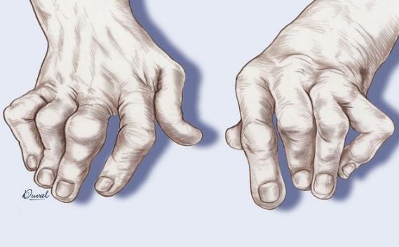 痛风为什么要补硒呢(痛风补硒有好处吗)-硒宝网