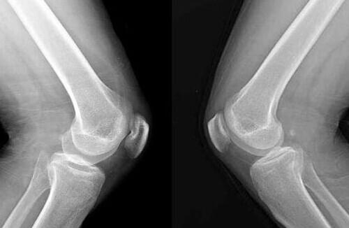 大骨节病需要补硒吗(病补骨节需要硒大剂量吗)-硒宝网