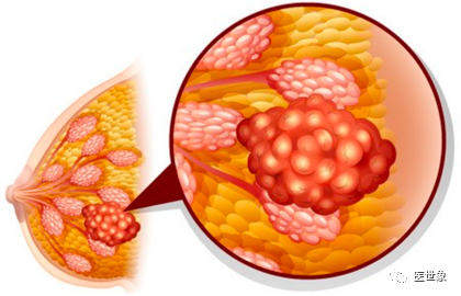 乳腺癌补硒患者自述(乳腺癌患者补硒元素好吗)-硒宝网