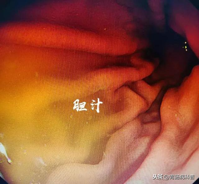 胆汁返流可以补硒吗(孕妇可以补硒吗)-硒宝网