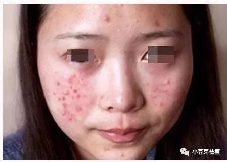 吃什么食物补硒和锌(锌补食物吃硒片有用吗)-硒宝网