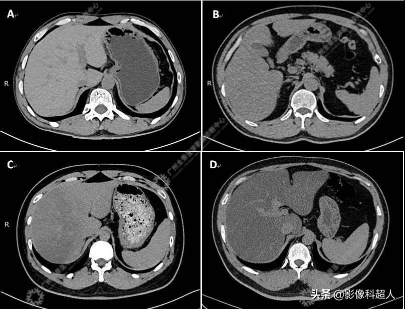 怎么调理脂肪肝补硒(调理肝脂肪补硒有用吗)-硒宝网