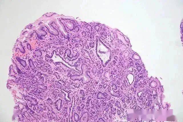 胆管癌病人怎样补硒(胆管癌喝什么营养粉)-硒宝网