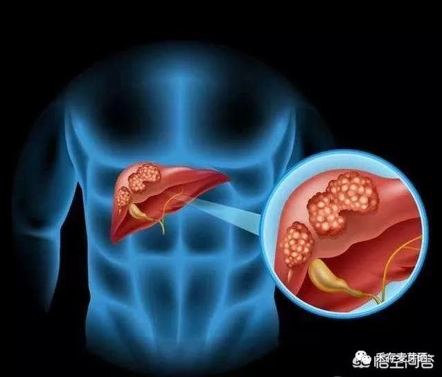 胰腺癌晚期黄疸补硒（胰腺癌补硒有什么好处）-硒宝网