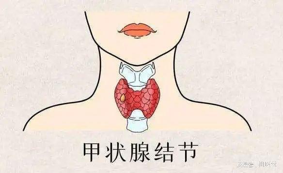 补硒预防甲状腺癌吗(硒对甲状腺癌的作用)-硒宝网