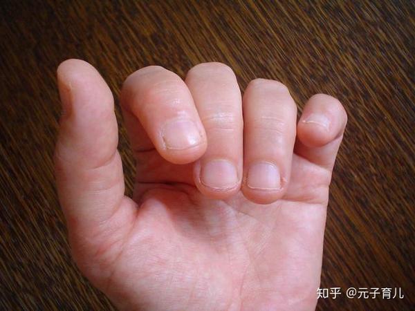 咬指甲缺什么微量元素(咬指甲缺维生素)-硒宝网