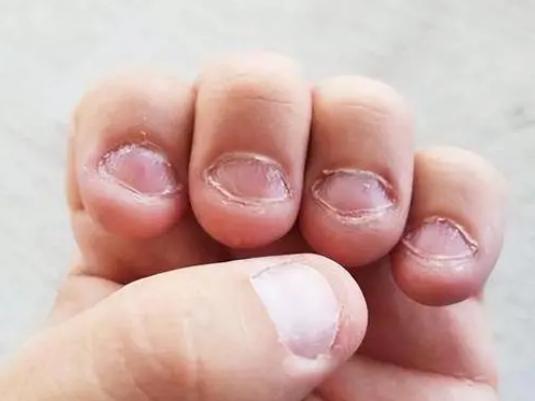 咬指甲缺什么微量元素(指甲缺乏微量元素)-硒宝网