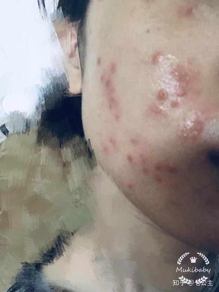 扁平疣医生开了补硒（补医生开扁平疣硒有用吗）-硒宝网