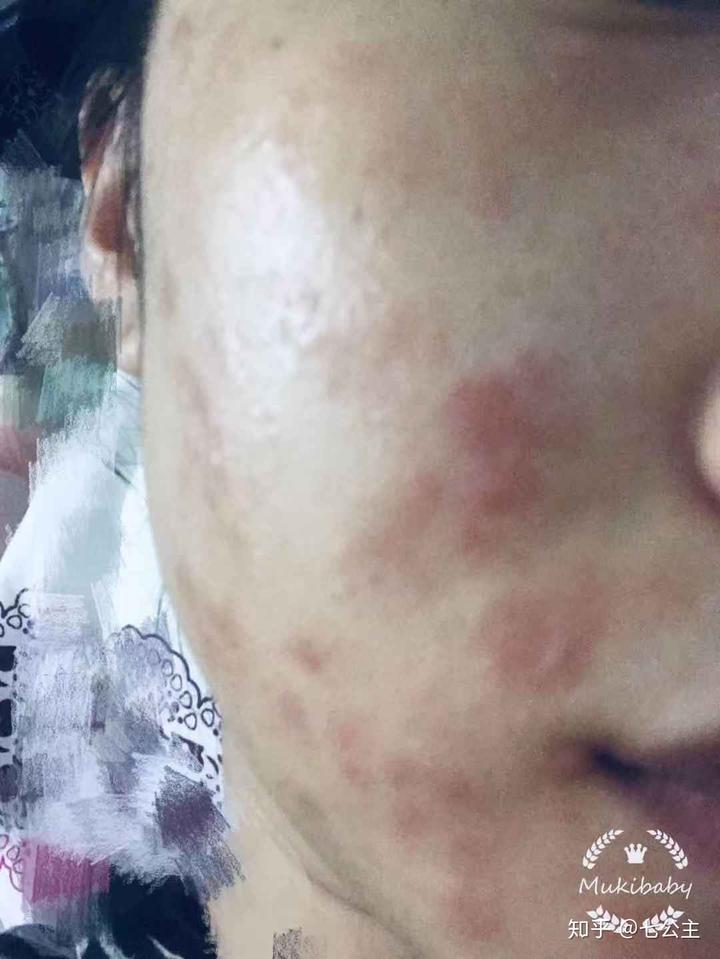 扁平疣医生开了补硒（补医生开扁平疣硒有用吗）-硒宝网