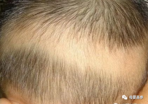 感冒期间可以补钙吗（感冒期间能补钙）-硒宝网