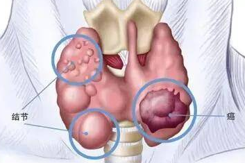 补硒与预防甲状腺癌(甲状腺癌补硒预防转移)-硒宝网