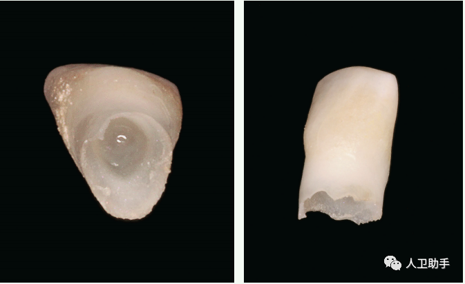 儿童换牙需要补钙吗(补钙儿童换牙需要多久)-硒宝网
